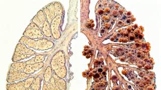 Lung Cancer Development From Mesothelioma