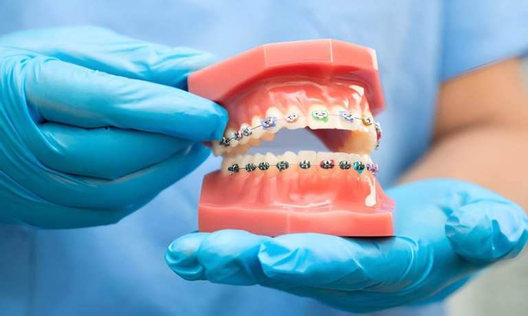 Read this, If You are thinking about Straightening Your Teeth