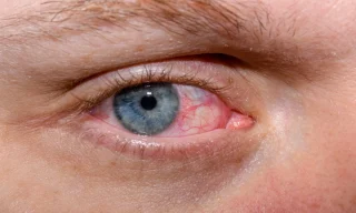 How Eye Doctors Treat Dry Eye Syndrome Effectively