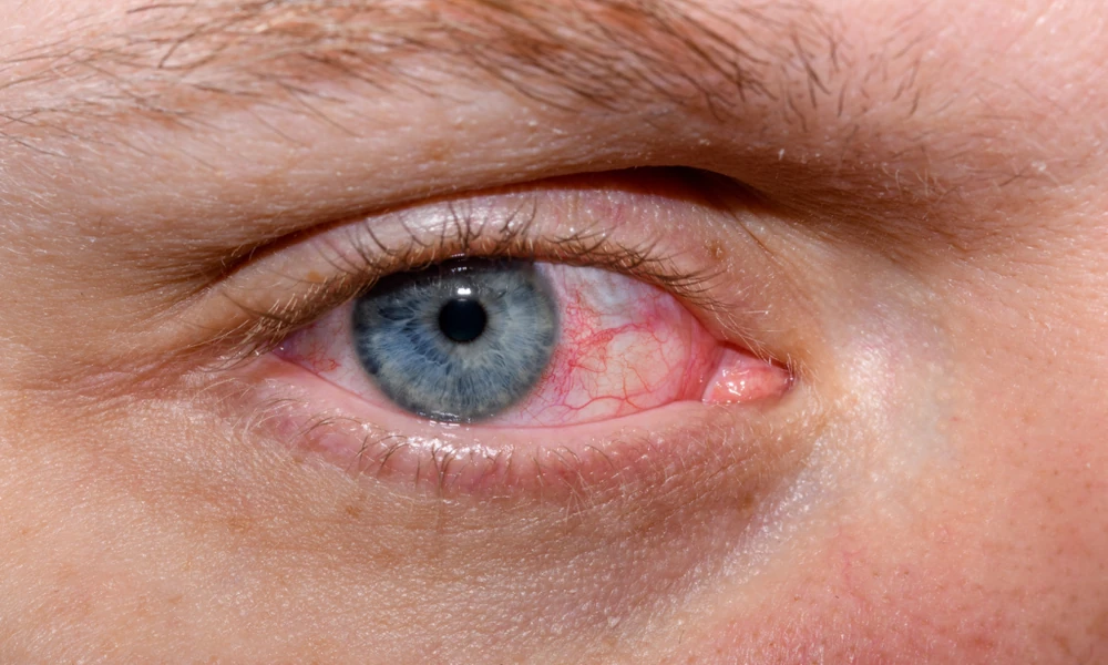 How Eye Doctors Treat Dry Eye Syndrome Effectively