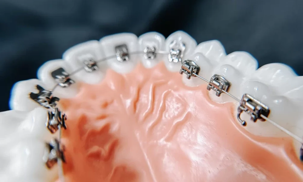 5 Common Myths About Orthodontic Treatment Debunked