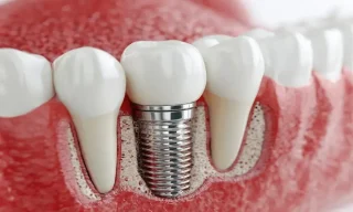 Why Cosmetic Planning Should Begin Before Dental Implant Surgery